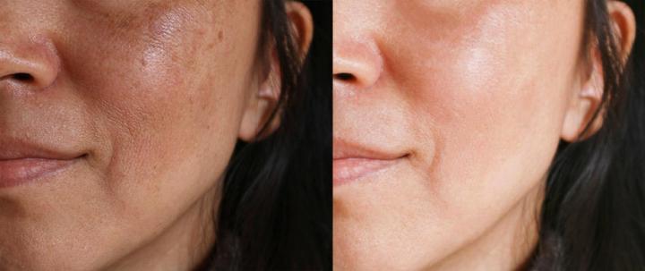 Transformative Brightening Facials Houston